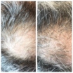 Zabieg ResurHair – odzyskaj utracone włosy