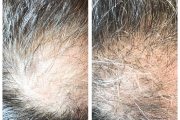 Zabieg ResurHair – odzyskaj utracone włosy